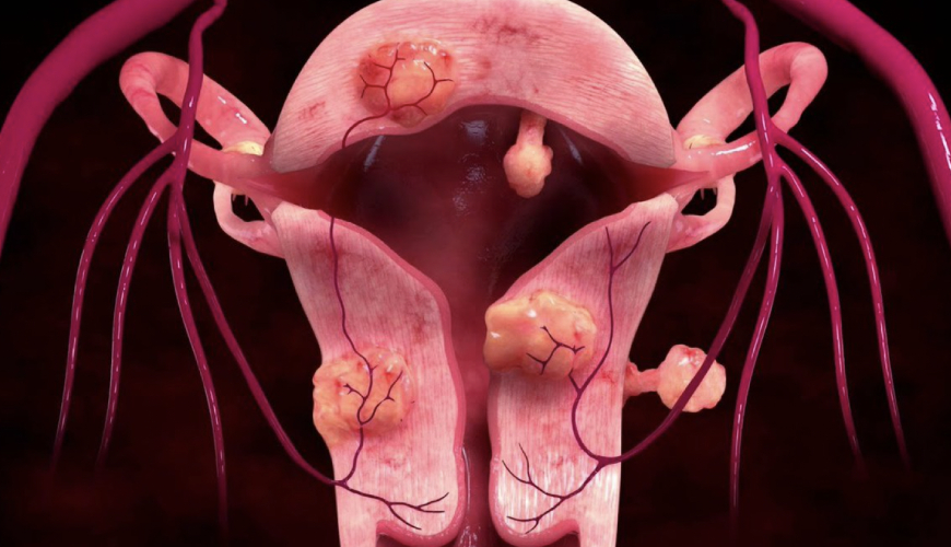 Sangrado Uterino